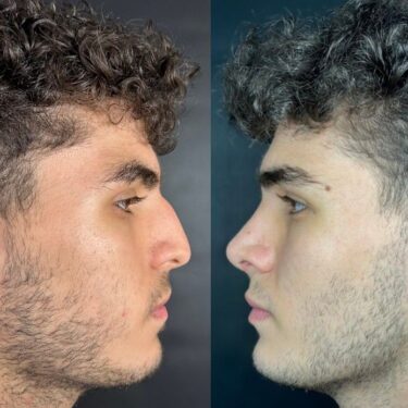 Rhinoplastik