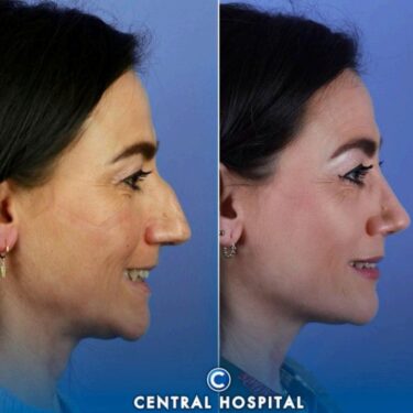 Rhinoplastik