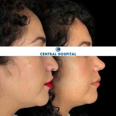 Rhinoplastik