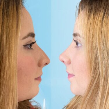 Rhinoplastik