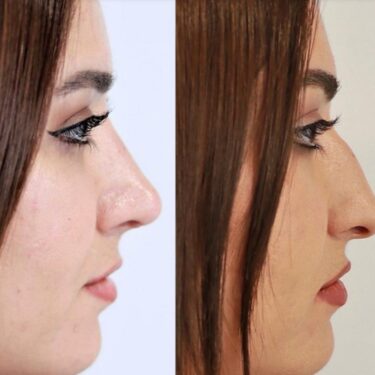 Rhinoplastik