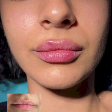 Lippenunterspritzung