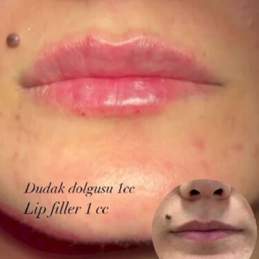 Lippenunterspritzung