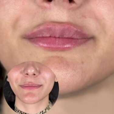 Lippenunterspritzung