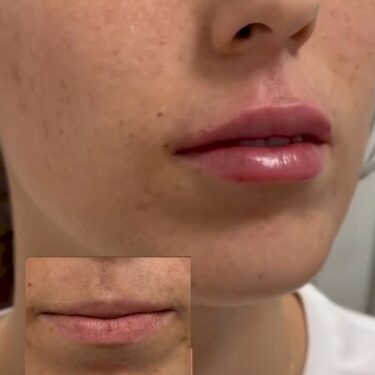Lippenunterspritzung