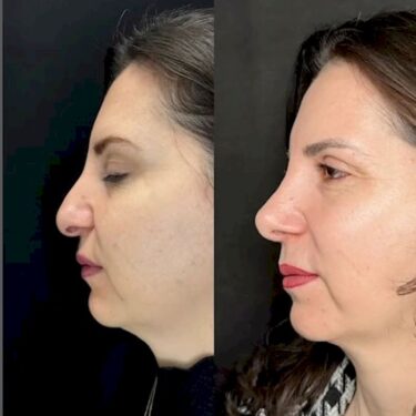 Nose job