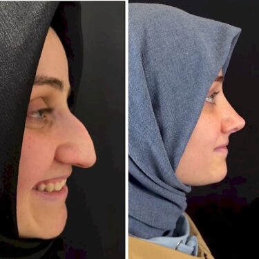Nose job