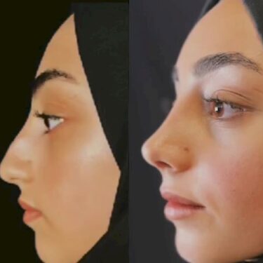 Nose job