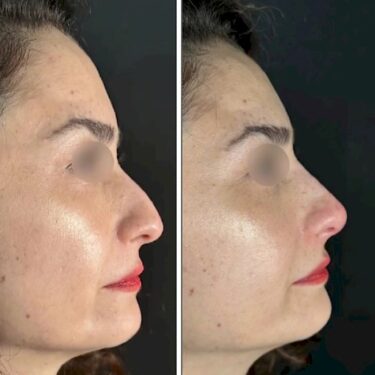 Nose job