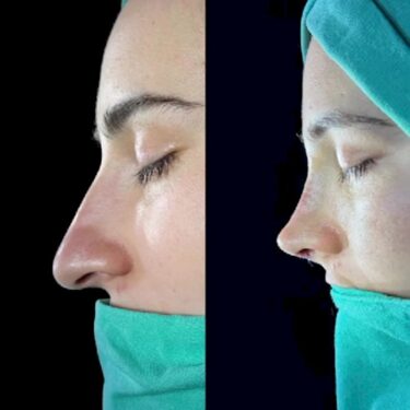 Nose job