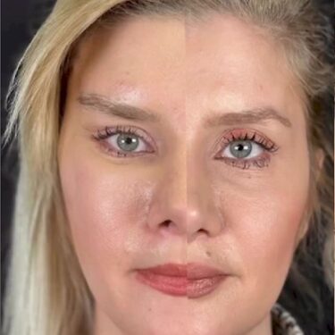 Gesichtsstraffung