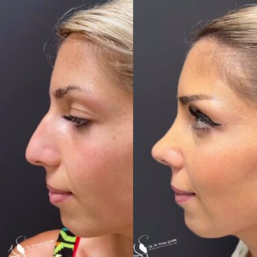 Rhinoplastik