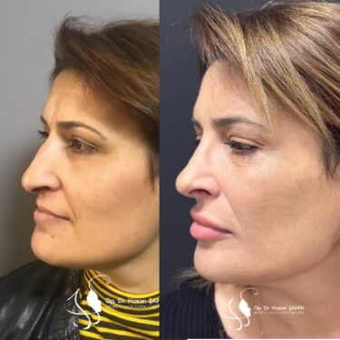 Rhinoplastik