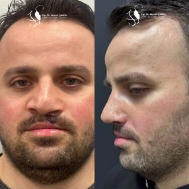 Rhinoplastik