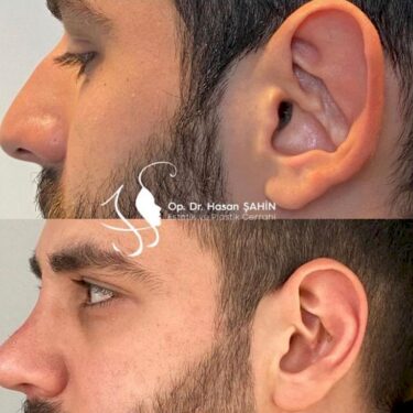 Otoplasty in Turkey
