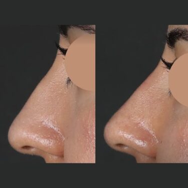 Nichtoperative Rhinoplastik