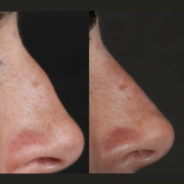 Nichtoperative Rhinoplastik