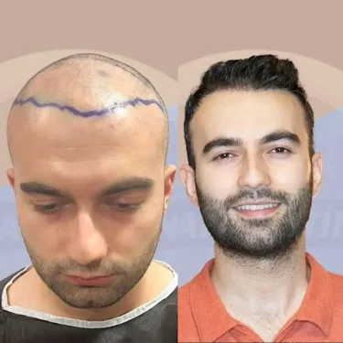 Haartransplantation