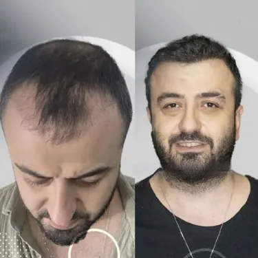 Haartransplantation