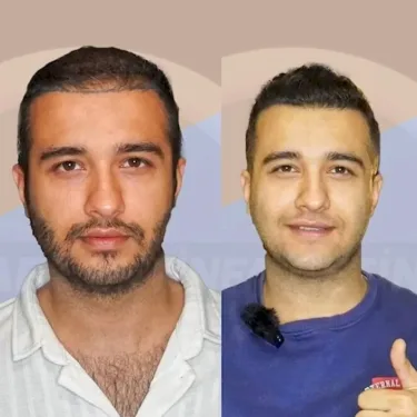 Haartransplantation