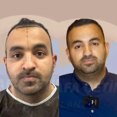 Haartransplantation