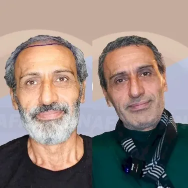 Haartransplantation