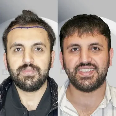 Haartransplantation