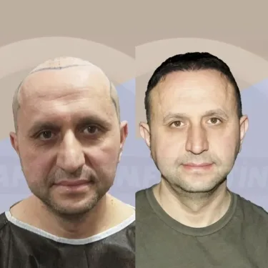 Haartransplantation