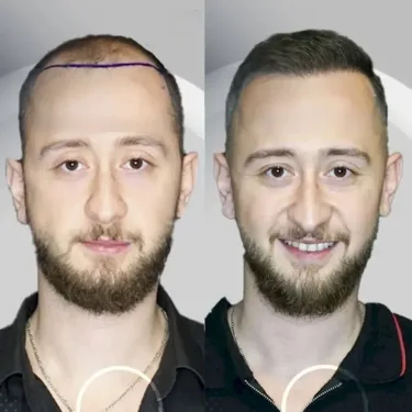 Haartransplantation