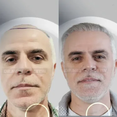 Haartransplantation