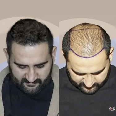 Haartransplantation