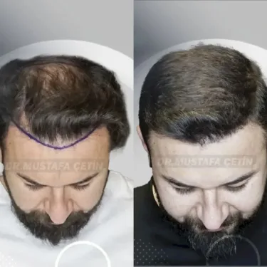 Haartransplantation