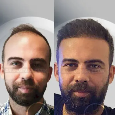 Haartransplantation