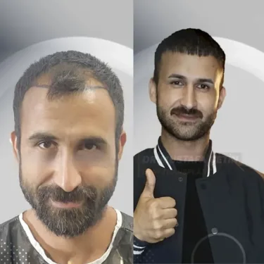 Haartransplantation