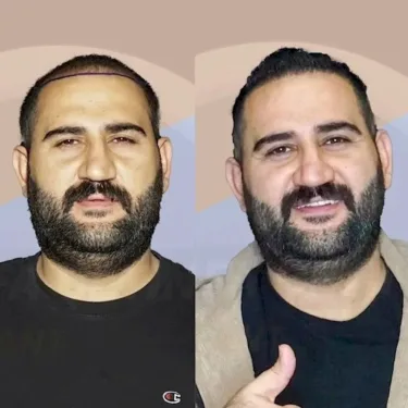 Haartransplantation