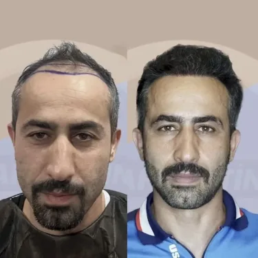 Haartransplantation