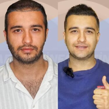 Пересадка волос