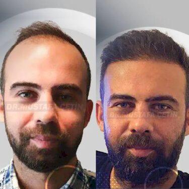 Пересадка волос