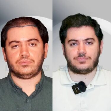 Пересадка волос