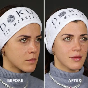 Lip fillers