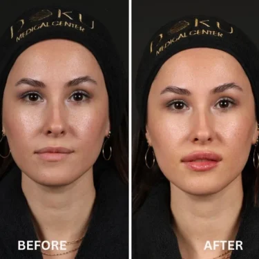 Lip fillers