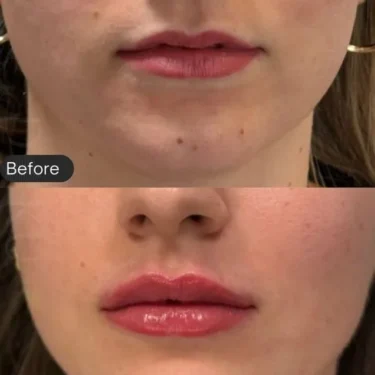 Lip fillers