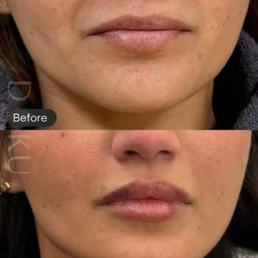 Lip fillers