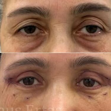 Блефаропластика