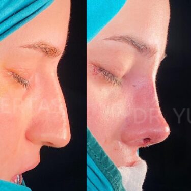 Ринопластика