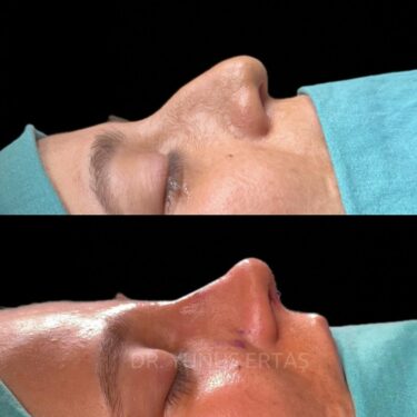 Ринопластика