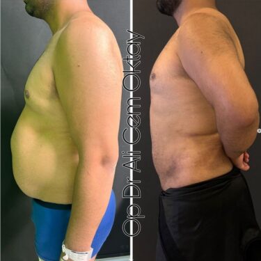 Гинекомастия с липосакцией