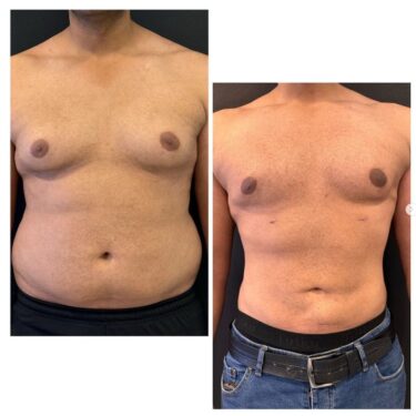 Гинекомастия с липосакцией