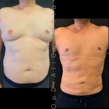 Гинекомастия с липосакцией