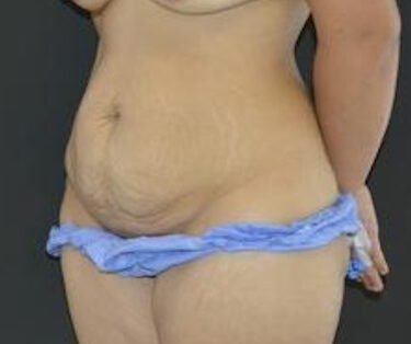 Липосакция